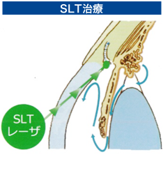 SLT治療