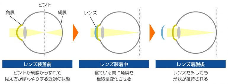 オルソケラトロジーとは