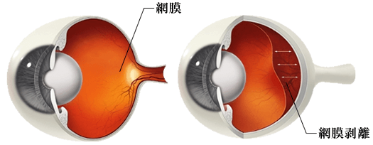 網膜 剥離 原因