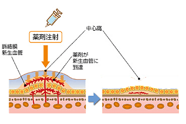 当院の抗VEFG薬治療（硝子体内注射）ルセンティス・アイリーアを使用しております